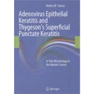 Despite differences in frequency, causation, and infectivity, adenovirus epithelial keratitis and Thygeson&apos;&apos;s superficial punctate keratitis (TSPK) are often confused in clinical practice owing to the similarity between adenovirus epithelial infiltrates and &apos;&apos;coarse&apos;&apos; epithelial TSPK lesions